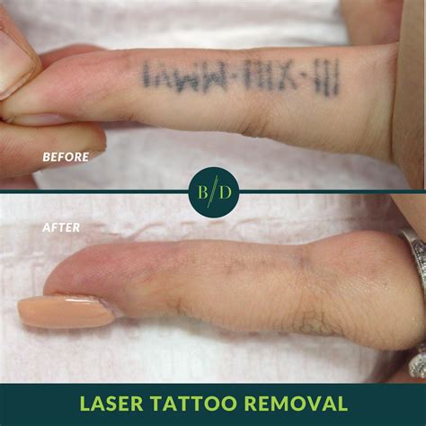 Laser Tattoo Removal .